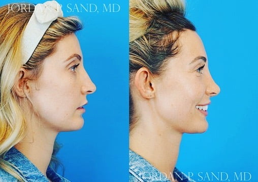 Rhinoplasty 49