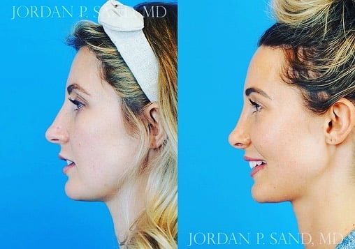 Rhinoplasty 49