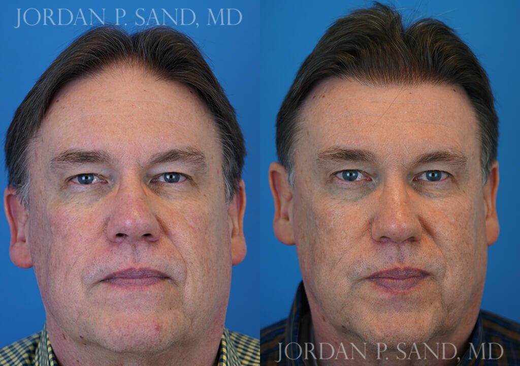 Hair Transplant 3