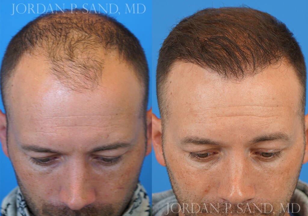 Hair Transplant 5