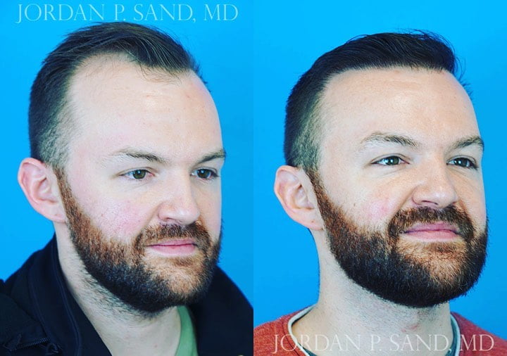Hair Transplant 6