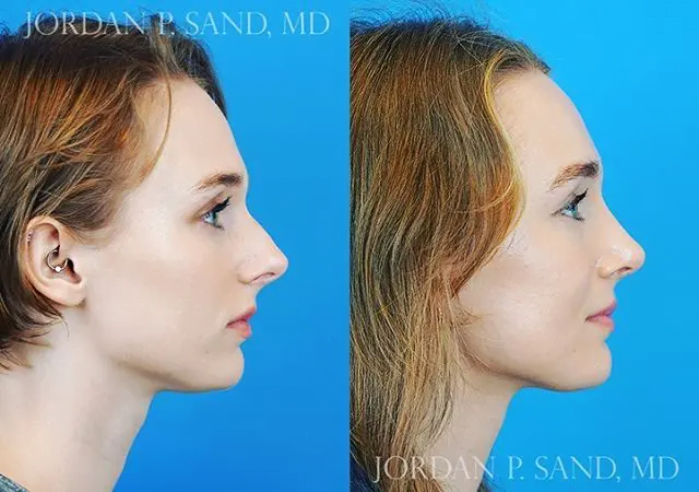 Rhinoplasty 23