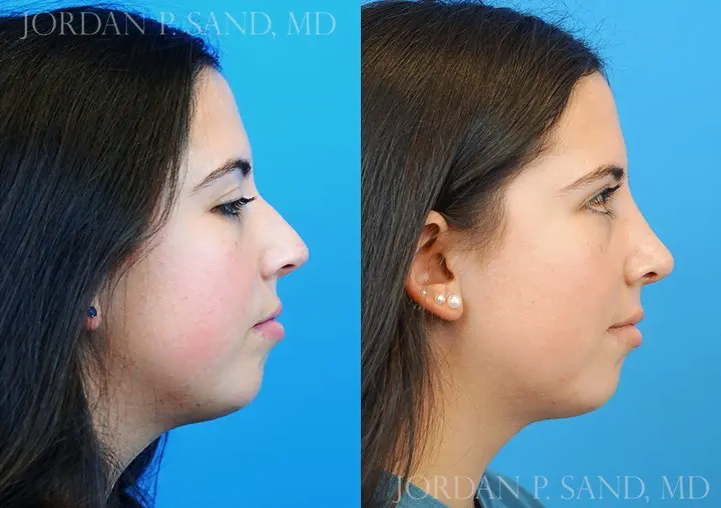 Revision Rhinoplasty 3