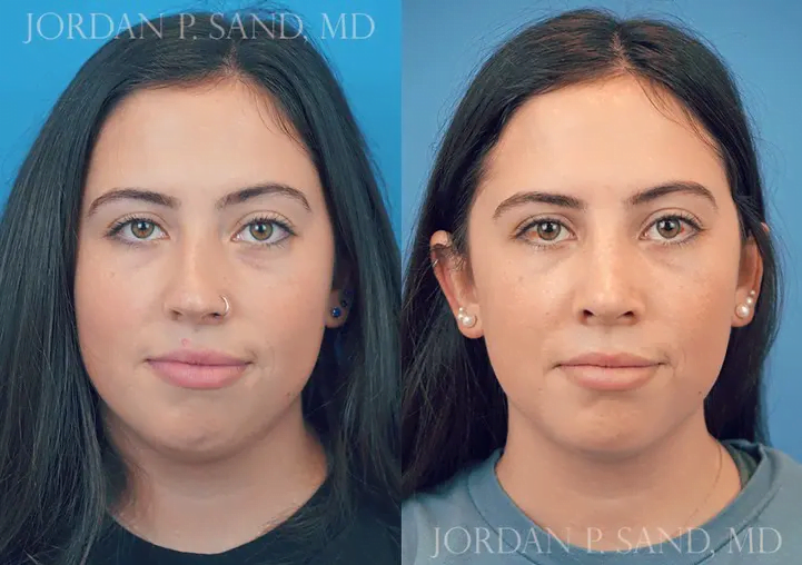 Revision Rhinoplasty 3