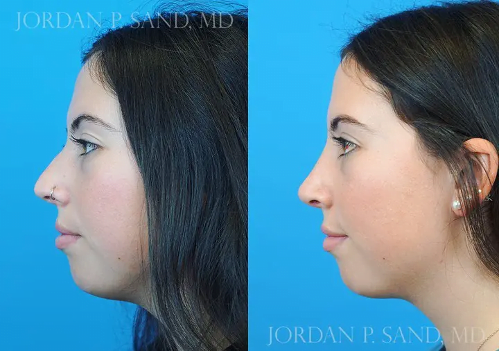 Revision Rhinoplasty 3