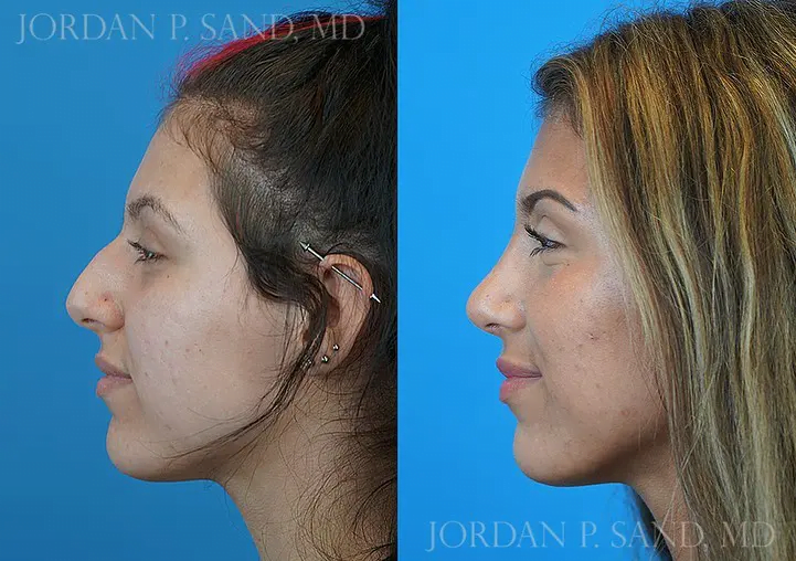Rhinoplasty 26