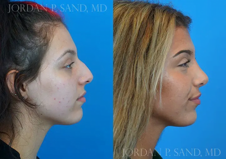 Rhinoplasty 26