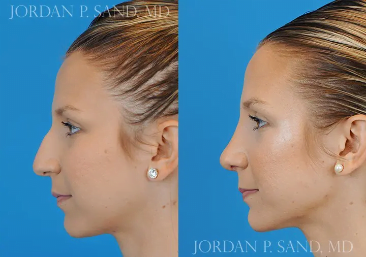 Rhinoplasty 27