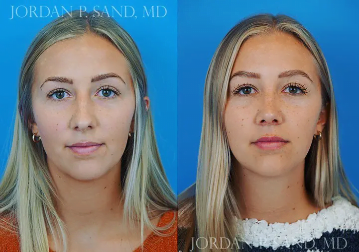 Rhinoplasty 30