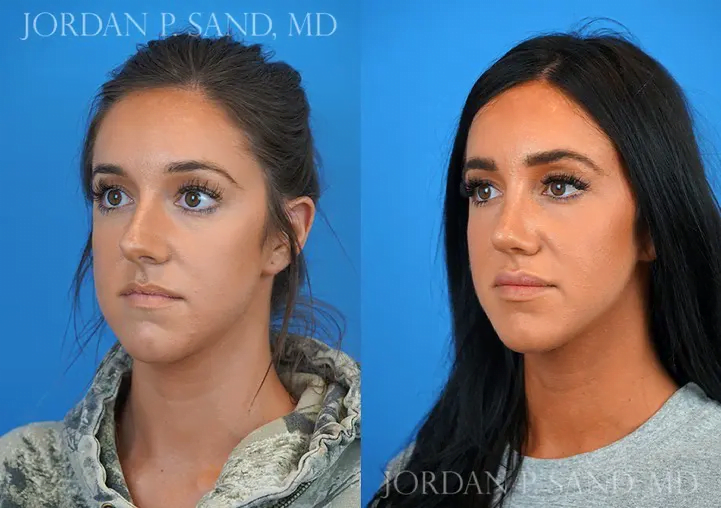 Rhinoplasty 31
