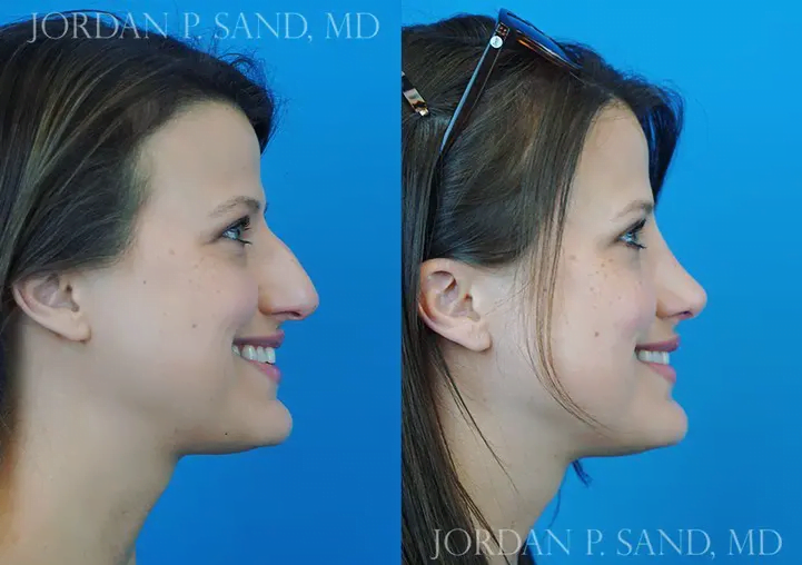 Rhinoplasty 33