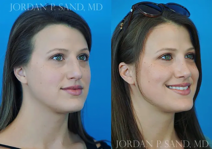 Rhinoplasty 33