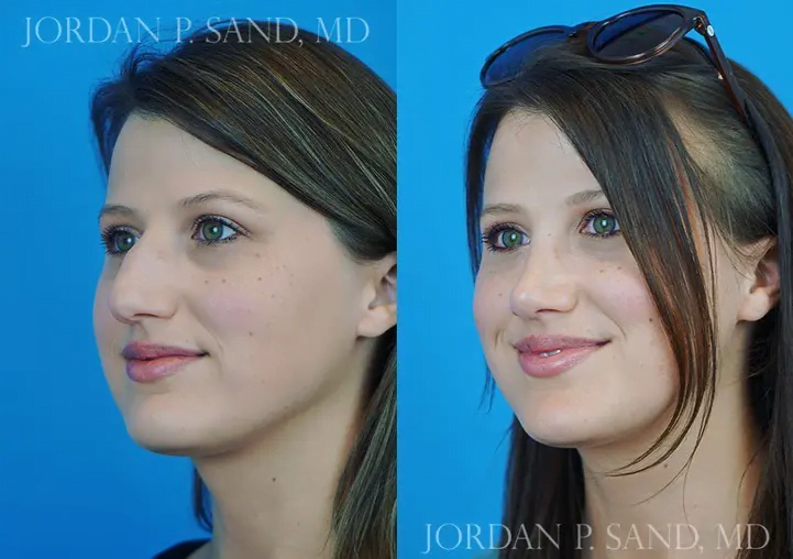 Rhinoplasty 33