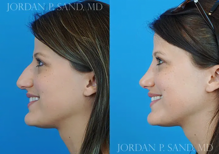 Rhinoplasty 33
