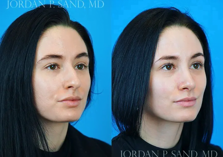 Rhinoplasty 34
