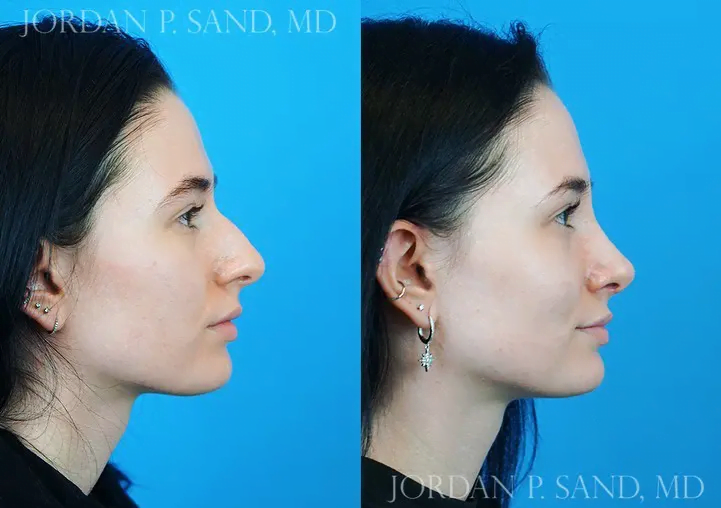 Rhinoplasty 34