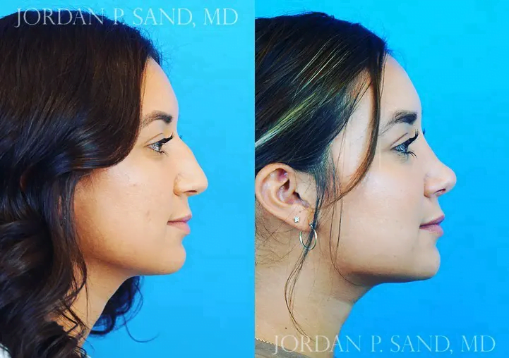 Rhinoplasty 35
