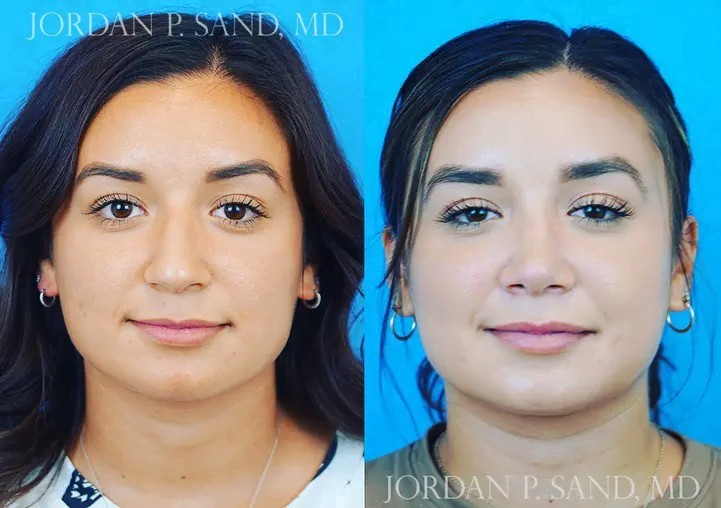 Rhinoplasty 35