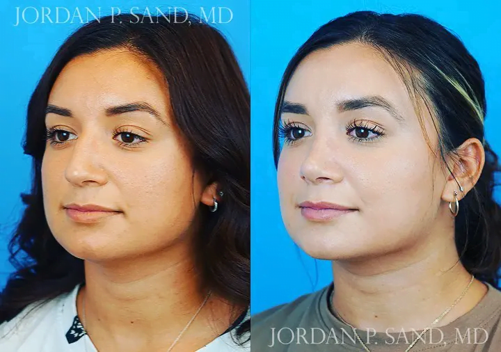 Rhinoplasty 35