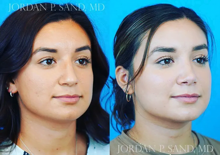 Rhinoplasty 35
