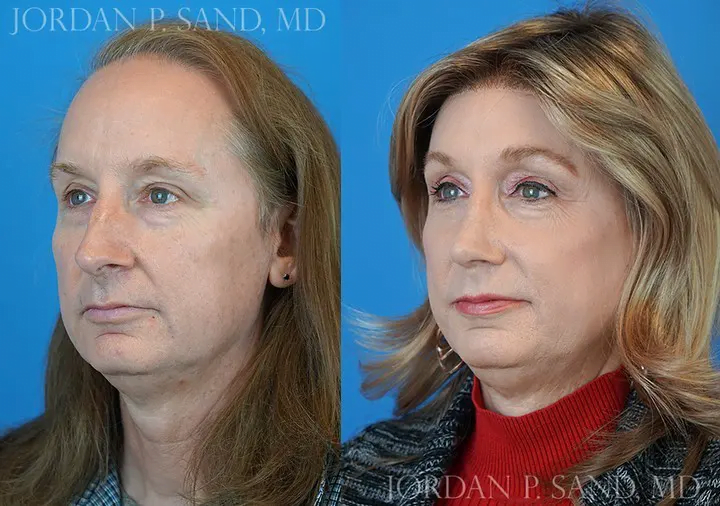 Rhinoplasty 36