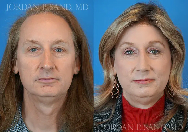 Rhinoplasty 36