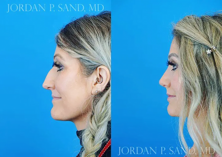 Rhinoplasty 37
