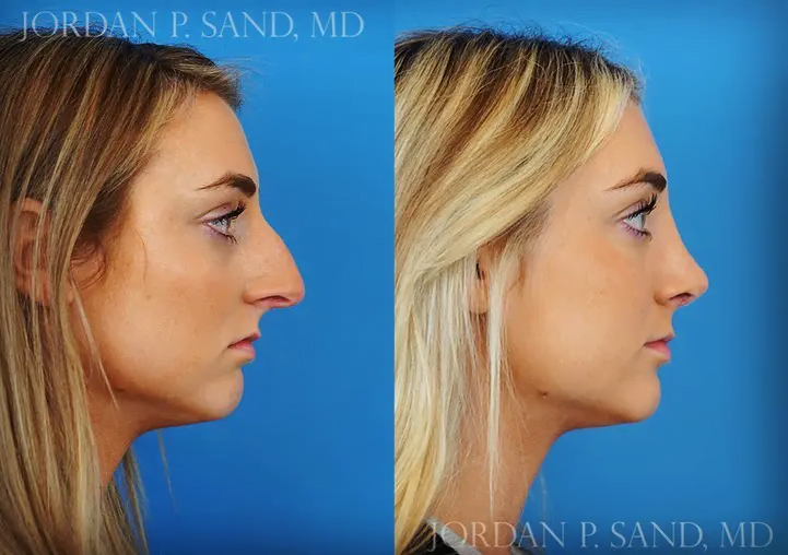 Rhinoplasty 39