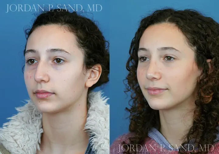 Rhinoplasty 40
