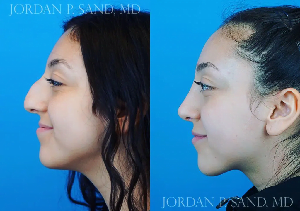 Rhinoplasty 42