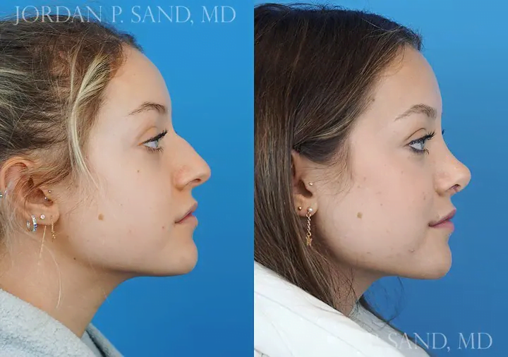 Rhinoplasty 43