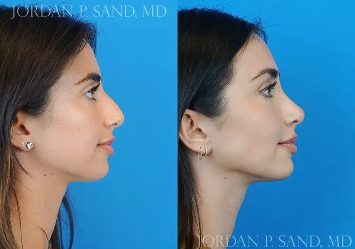 Rhinoplasty 44