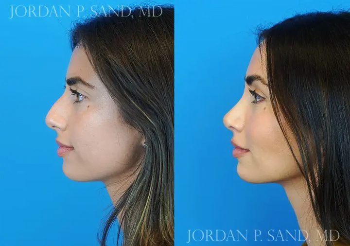 Rhinoplasty 44