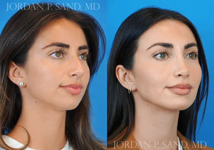 Rhinoplasty 44