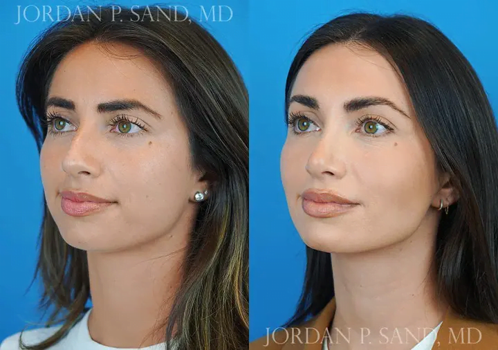 Rhinoplasty 44