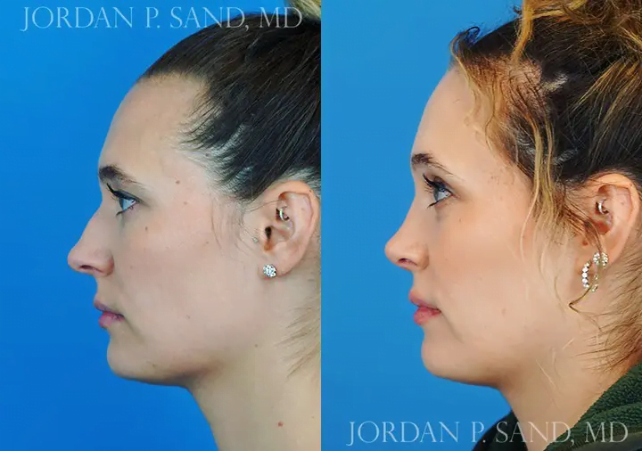 Rhinoplasty 45
