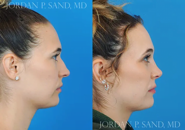 Rhinoplasty 45