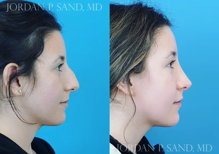 Rhinoplasty 46