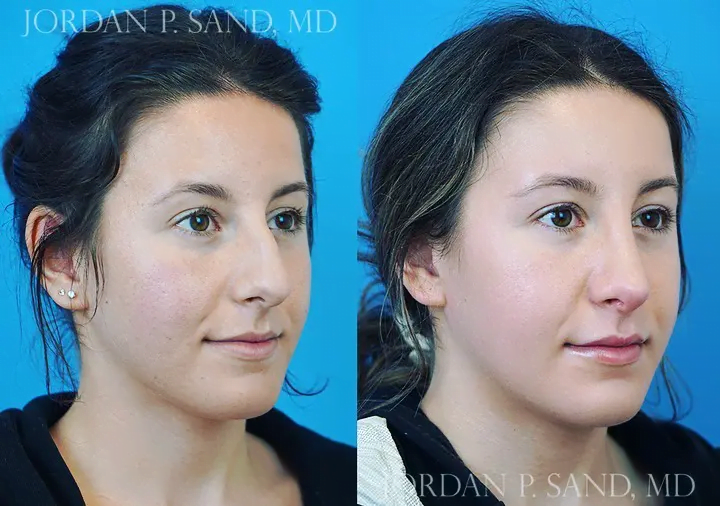Rhinoplasty 46