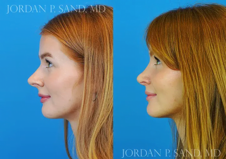 Rhinoplasty 47
