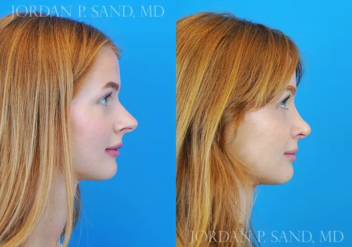 Rhinoplasty 47