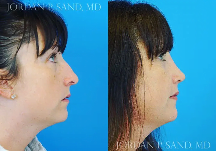 Rhinoplasty 48