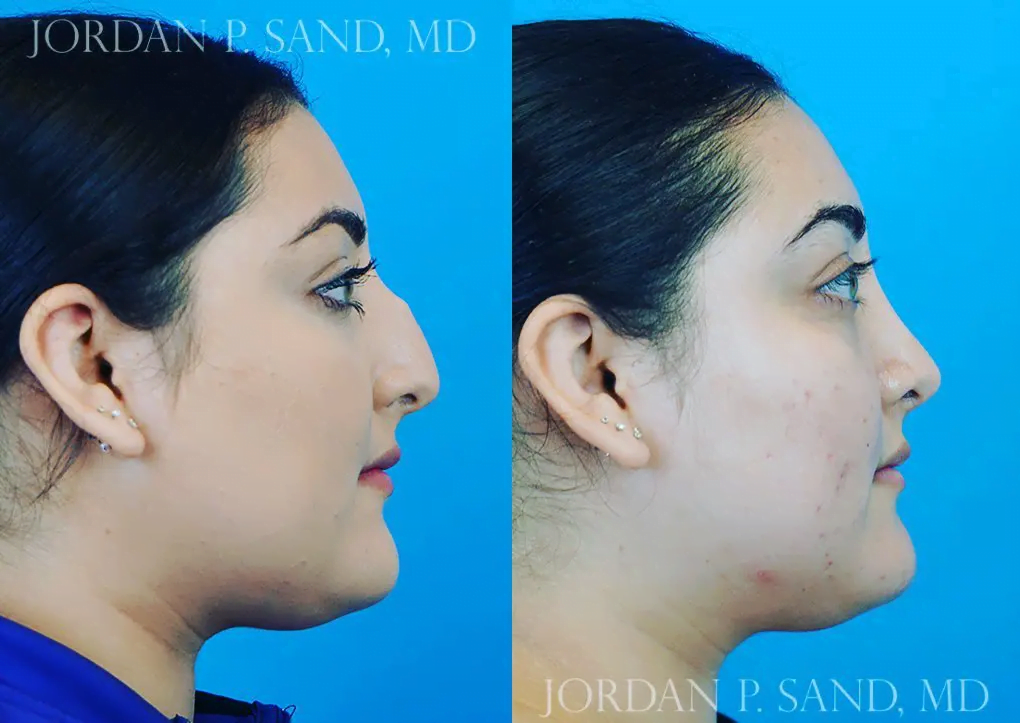 Rhinoplasty 50