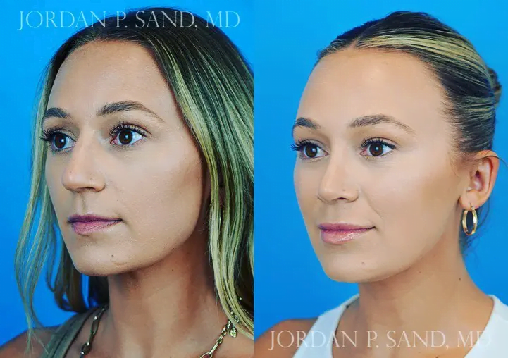 Rhinoplasty 54
