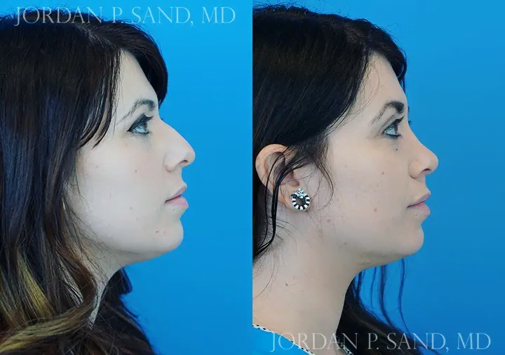 Rhinoplasty 56