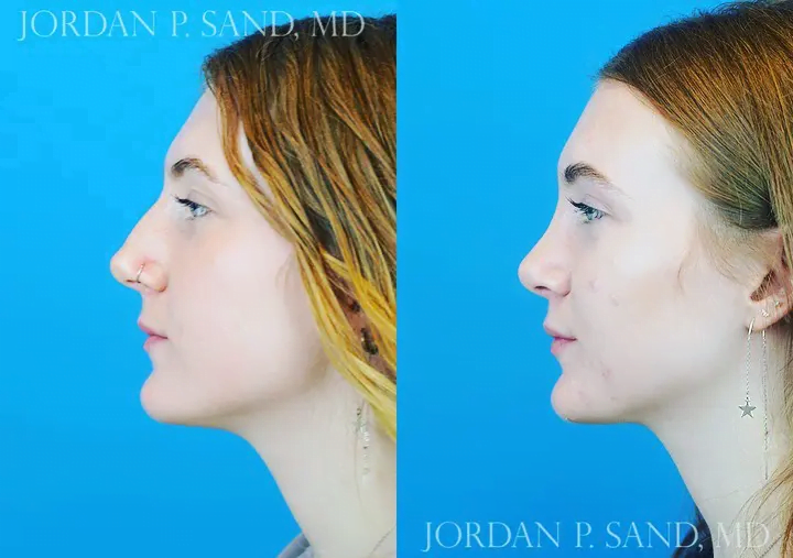 Rhinoplasty 57