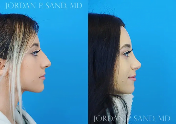 Rhinoplasty 59