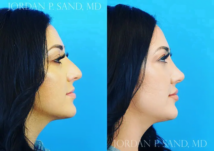 Rhinoplasty 60