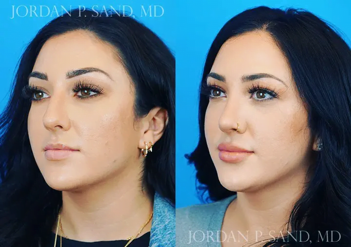 Rhinoplasty 60