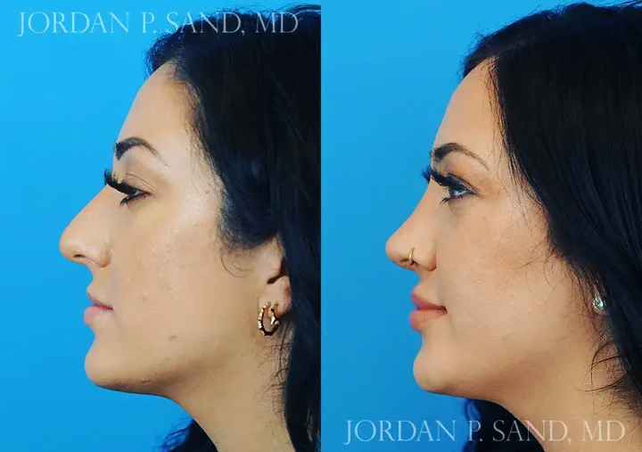 Rhinoplasty 60